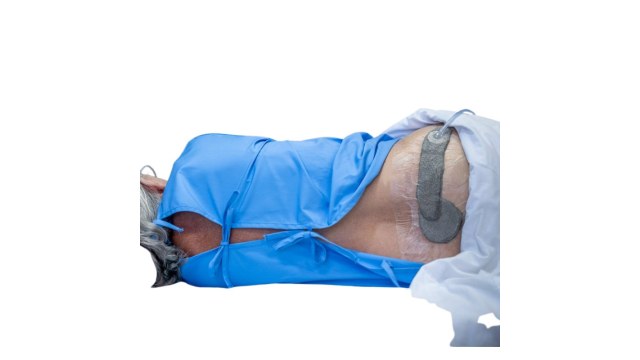 Negative Pressure Wound Therapy – NPWT