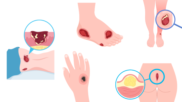 Pressure Ulcers: How to Prevent and Manage Painful Complications