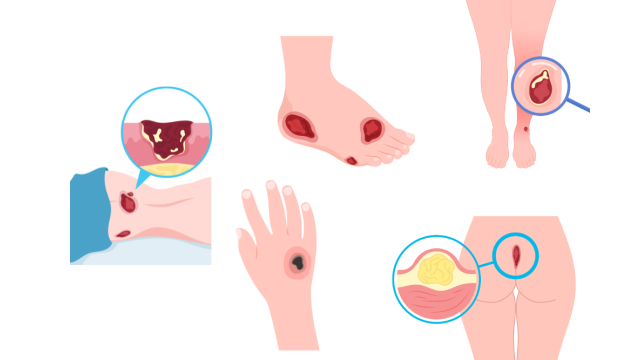 Pressure Ulcers: How to Prevent and Manage Painful Complications
