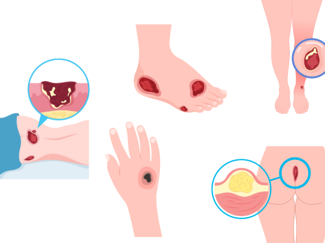 Pressure Ulcers: How to Prevent and Manage Painful Complications