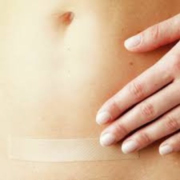 Braun Askina Scar Repair 2x14cm   - Silicone Sheet for Scars and Keloids