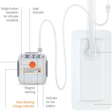 PICO 7 – Επίθεμα Αρνητικής Πίεσης Μίας Χρήσης (sNPWT)