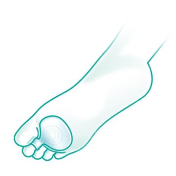 Oppo 6442 Anatomical Metatarsal Pads