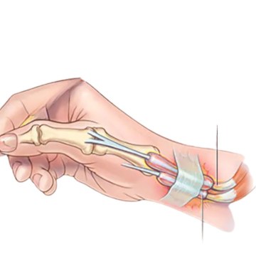 Νάρθηκας καρπού-παλάμης Standard Thumb με στήριξη αντίχειρα (One Size) 