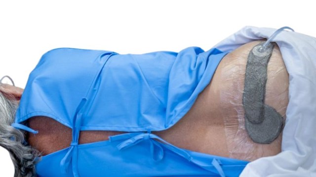 Θεραπεία Αρνητικής Πίεσης για Έλκη και Τραύματα Θεραπεία Αρνητικής Πίεσης για Έλκη και Τραύματα